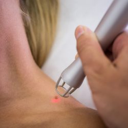 皮肤学家用医疗激光清除妇女肩部的内核